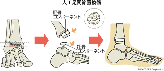 人工足関節置換術