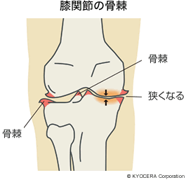 膝関節の骨棘