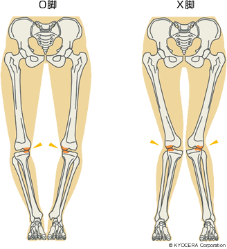 O脚 X脚