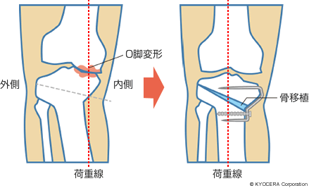 骨切り術の例