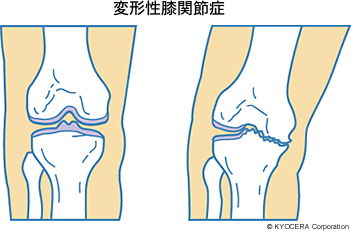 変形性膝関節症