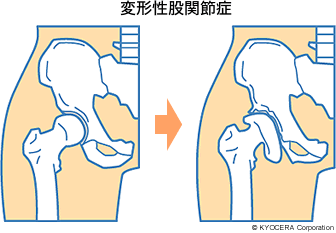 変形性股関節症