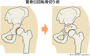 寛骨臼回転骨切り術