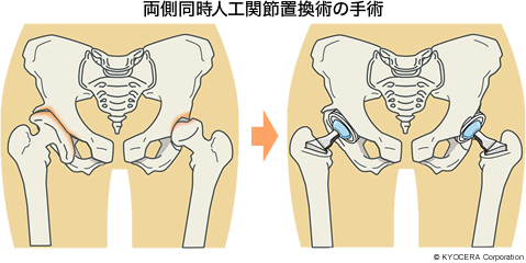 両側同時人工関節置換術の手術