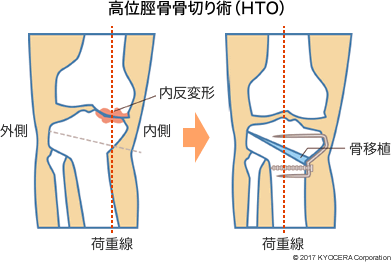 高位脛骨骨切り術（HTO）