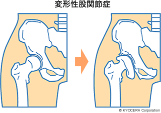 変形性股関節症