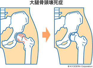 大腿骨頭壊死症