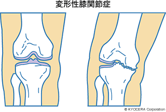 変形性膝関節症