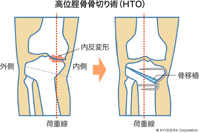 高位脛骨骨切り術（HTO）