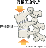 脊椎圧迫骨折