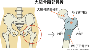 大腿骨頸部骨折