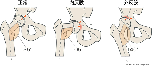 正常 内反股 外反股