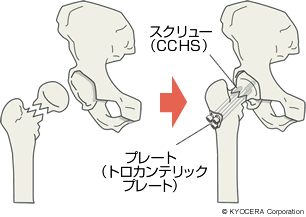 CCHSを用いた手術