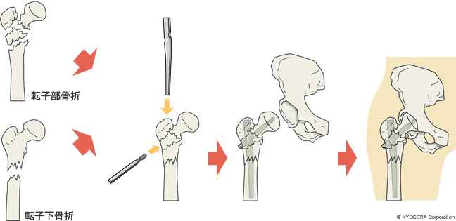 髄内釘を用いた手術