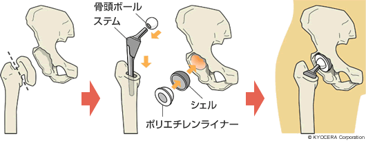 全人工股関節置換術