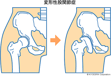 変形性股関節症