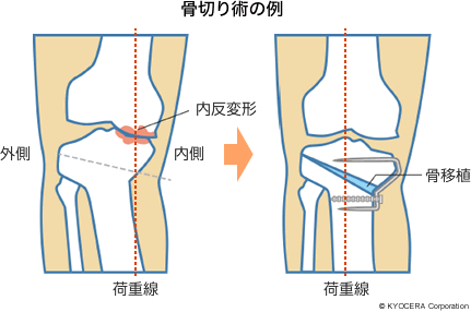 骨切り術の例