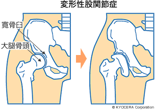 変形性股関節症