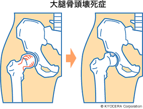 大腿骨頭壊死症