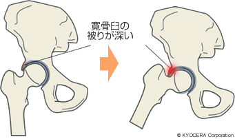 寛骨臼の被りが深い