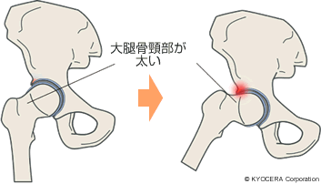 大腿骨頸部が太い