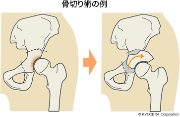 骨切り術の例