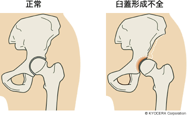 正常 臼蓋形成不全