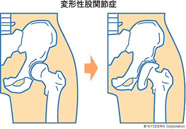 変形性股関節症