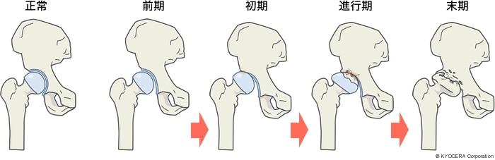 関節症の病期