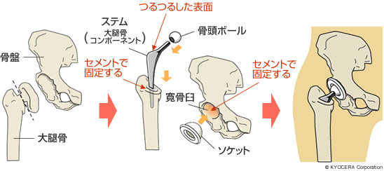 セメントを使用する人工股関節置換術