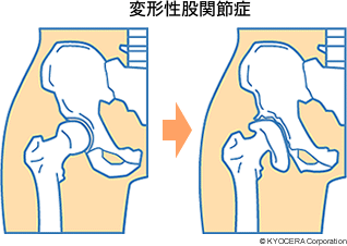 変形性股関節症