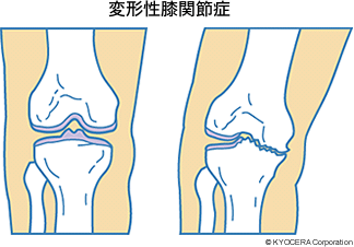 変形性膝関節症