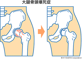 大腿骨頭壊死症