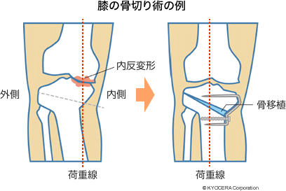 膝の骨切り術の例