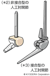 （＊2）非接合型の人工肘関節（＊3）接合型の人工肘関節