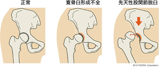 正常 寛骨臼形成不全 先天性股関節脱臼