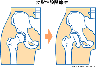 変形性股関節症