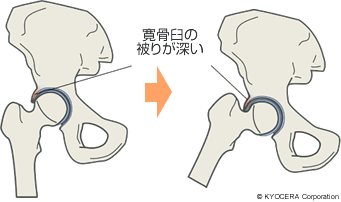 FAIの原因 寛骨臼の被りが深い