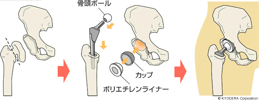 人工股関節置換術