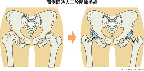 両側同時人工股関節手術