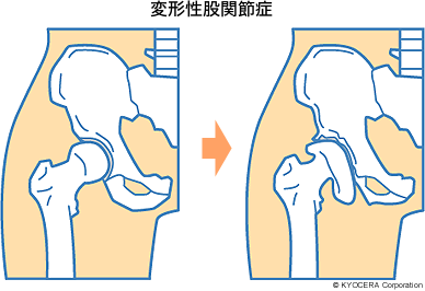 変形性股関節症