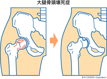 大腿骨頭壊死症