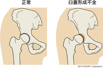 正常 臼蓋形成不全