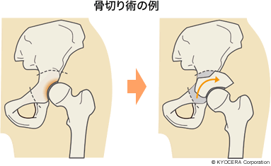 骨切り術の例