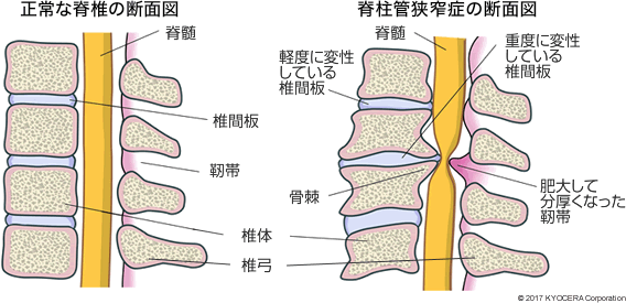 脊柱管狭窄症 三雲 仁 腰部脊柱管狭窄症の手術手技は十分に確立されています 安全性は高いといえるでしょう 相馬 真 何より大事なのはきちんとした診断 総合的判断です 最小の治療で最大の効果を得るためです