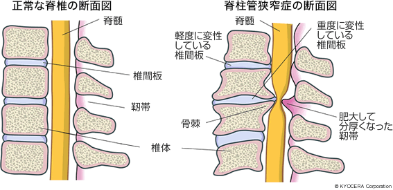 正常な脊椎の断面図 脊柱管狭窄症の断面図