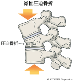 脊椎圧迫骨折