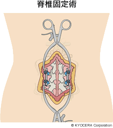 脊椎固定術