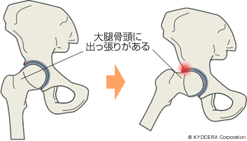 FAIの原因 大腿骨頭に出っ張りがある