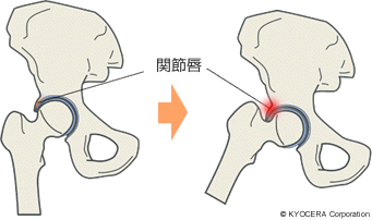 FAIの原因 関節唇